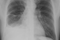 Cxr Pa