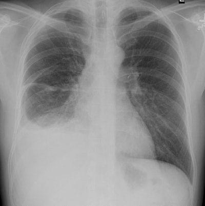 Cxr Pa