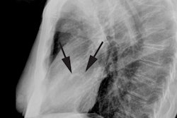 Cxr Lat
