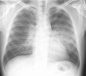 /ScottWilliamsMD2/CHEST/Autoimmune/Proteinosis/Images/Case2/cxr_sm.jpg (16282 bytes)