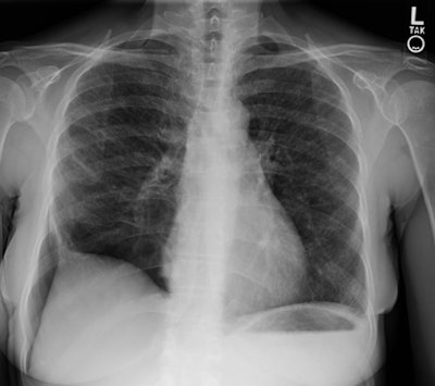 Cxr Small