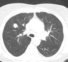 Carcinoid Ct
