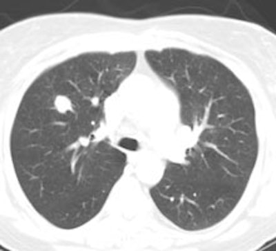 Carcinoid Ct