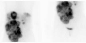 Carcinoid Octr Planar