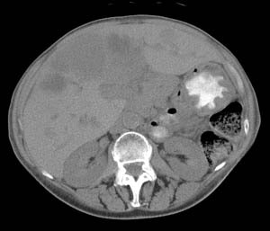 Carcinoiod Ct