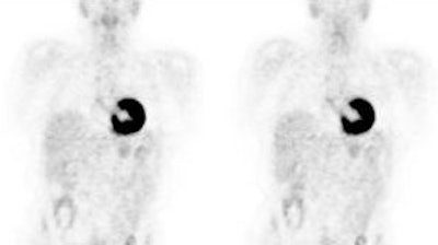 PET > PET tumor imaging > General | AuntMinnie