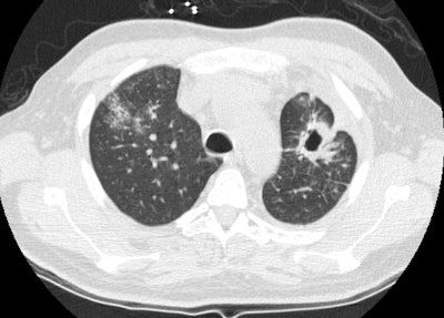 Case 2 Ct1