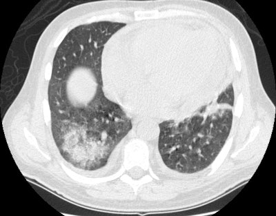 Case 2 Ct3