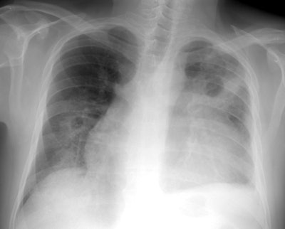 Case 2 Pa Cxr Small