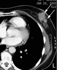 Case2 Ct2