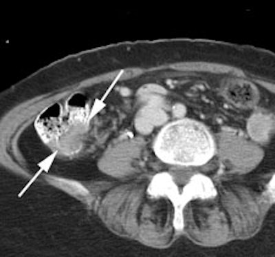 Cecum Ct