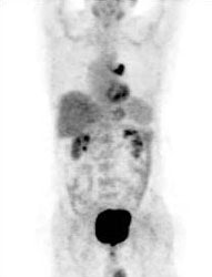 Central Tumor