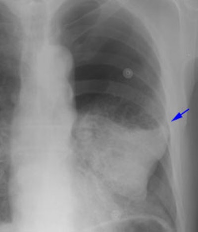 Chest Wall Post Ptx S