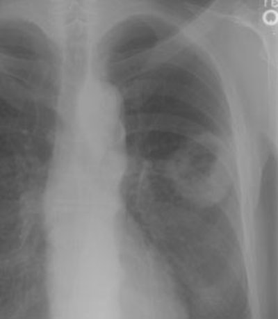 Chest Wall Pre Ptx S