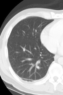 /ScottWilliamsMD2/CHEST/Tumor/Benign/AVM/Images/Case2/cine.gif (528756 bytes)