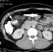 Colon Ca Ct Sm