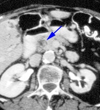 Commonduct_CT_sm.JPG (20842 bytes)