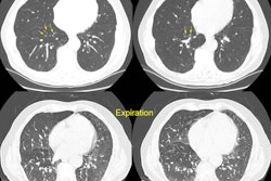 Constrictive Bronciolitis