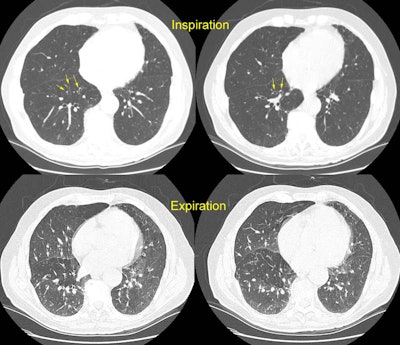 Constrictive Bronciolitis