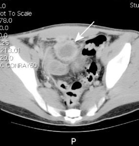 Crohns_abscess_CT__sm.jpg (15986 bytes)