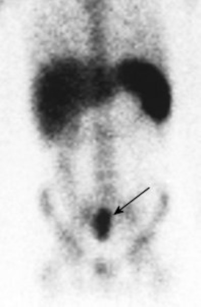 Crohns_abscess_WBC.jpg (8845 bytes)