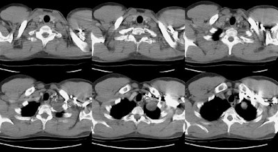 /ScottWilliamsMD2/CHEST/Mediastinum/Schwannoma/Images/Case1/ct.jpg (89256 bytes)