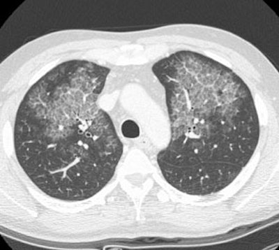 /ScottWilliamsMD2/CHEST/Autoimmune/Proteinosis/Images/Case2/ct1_sm.jpg (27061 bytes)