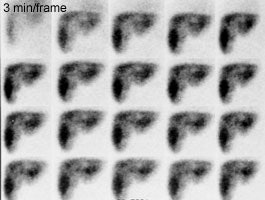 Cyst_HIDA.JPG (17730 bytes)