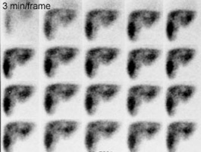 Cyst_HIDA.JPG (17730 bytes)