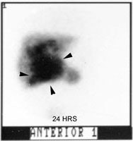 Cyst_HIDA_late_sm.JPG (10057 bytes)