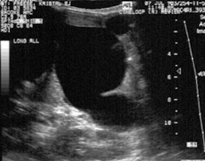 Cyst_US_sm.JPG (19020 bytes)