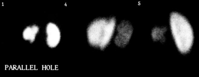 DMSA scar1.JPG (11135 bytes)