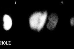 DMSA scar1.JPG (11135 bytes)