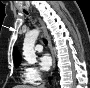 Ectopic Ct2