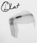 Enchondroma_BS2.JPG (5039 bytes)