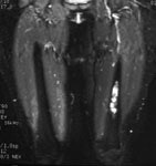 Enchondroma_MRT2_sm.JPG (8659 bytes)