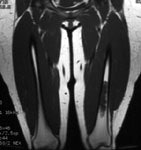 Enchrondroma_MRT1_sm.JPG (10457 bytes)