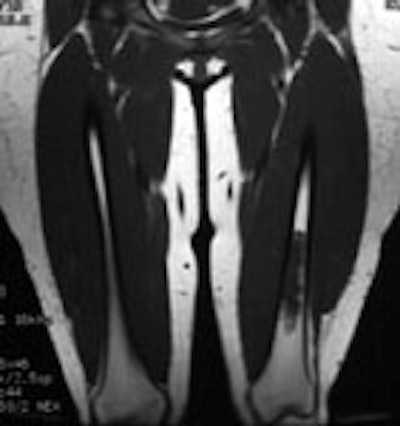 Enchrondroma_MRT1_sm.JPG (10457 bytes)