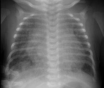 Endocardial Cushion Sm