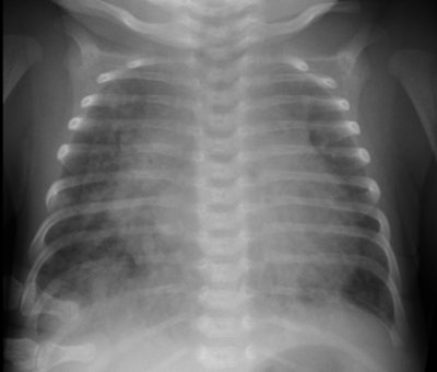 Endocardial Cushion Sm