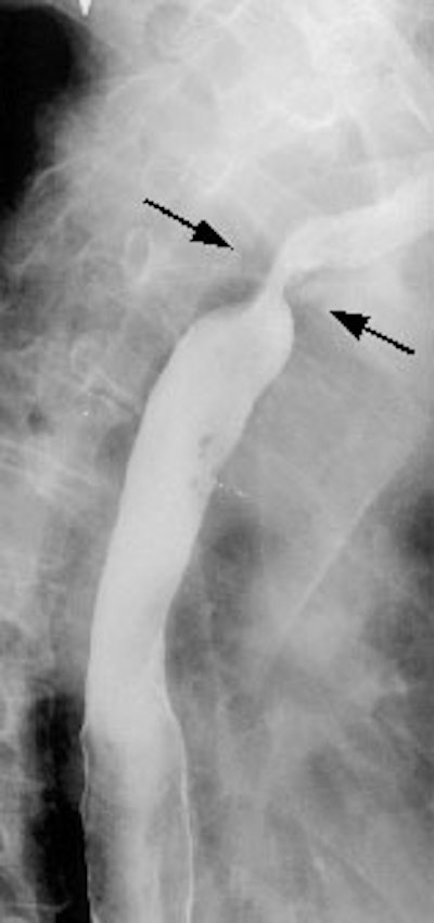 Esophagus Ba Swallow