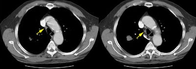 False Neg N2 Nodes S