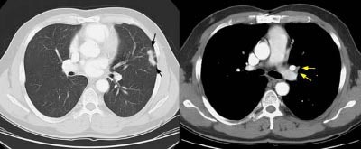 False Neg New Criteria Hila Nodes S