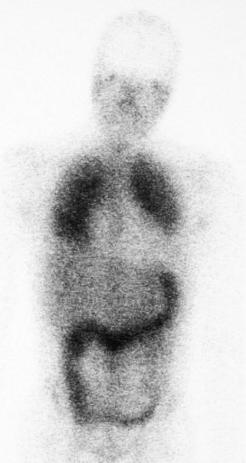 /ScottWilliamsMD2/CHEST/Infect/Parasites/PCP/Images/PCP-Ga-67/ga-67.jpg (63132 bytes)