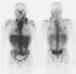 Ga67_Lymphoma_sm.JPG (12580 bytes)