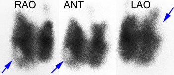 Graves_papcarcinoma.JPG (17791 bytes)