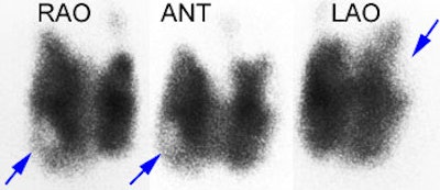 Graves_papcarcinoma.JPG (17791 bytes)