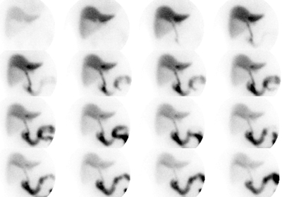 HIDA_Acute_Chole.jpg (48062 bytes)