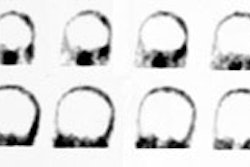 HMPAO_brain_death.JPG (12750 bytes)