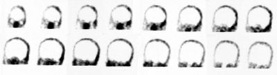 HMPAO_brain_death.JPG (12750 bytes)